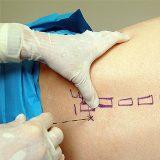 Блокады от болей в спине и пояснице (паравертебральная блокада)