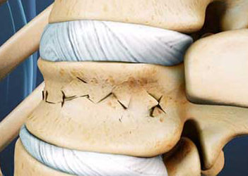 Реабилитация при компрессионном переломе позвоночника