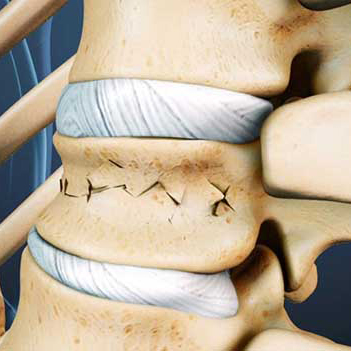Реабилитация при компрессионном переломе позвоночника
