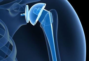 Реабилитация после эндопротезирования плечевого сустава