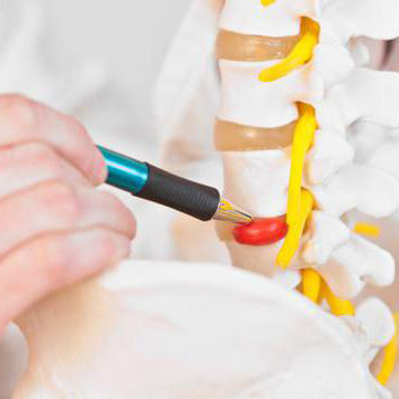 Реабилитация после удаления межпозвонковой грыжи