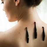 Гирудотерапия