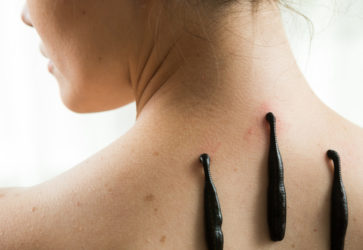 Гирудотерапия