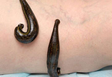 Гирудотерапия при варикозе