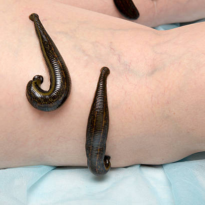 Гирудотерапия при варикозе