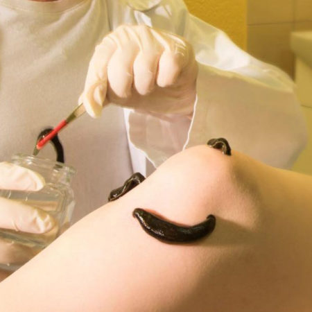 Гирудотерапия с иглорефлексотерапией