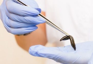 Первичная консультация гирудотерапевта